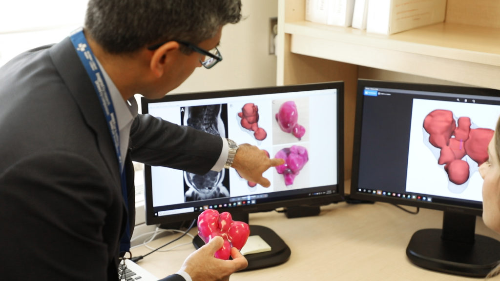 Dr. Sony Singh uses 3D printed model for complex surgery.