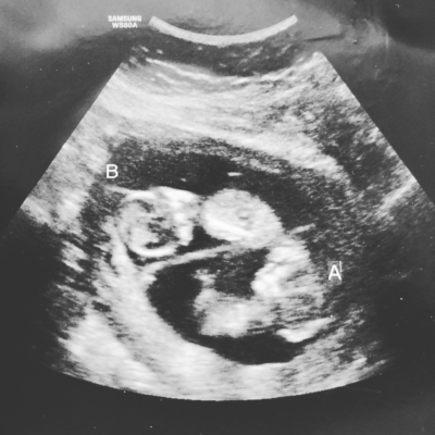 Meagan's Ultrasound