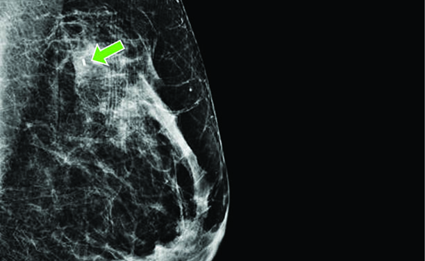 Radioactive seeds increase surgical accuracy for breast cancer patients