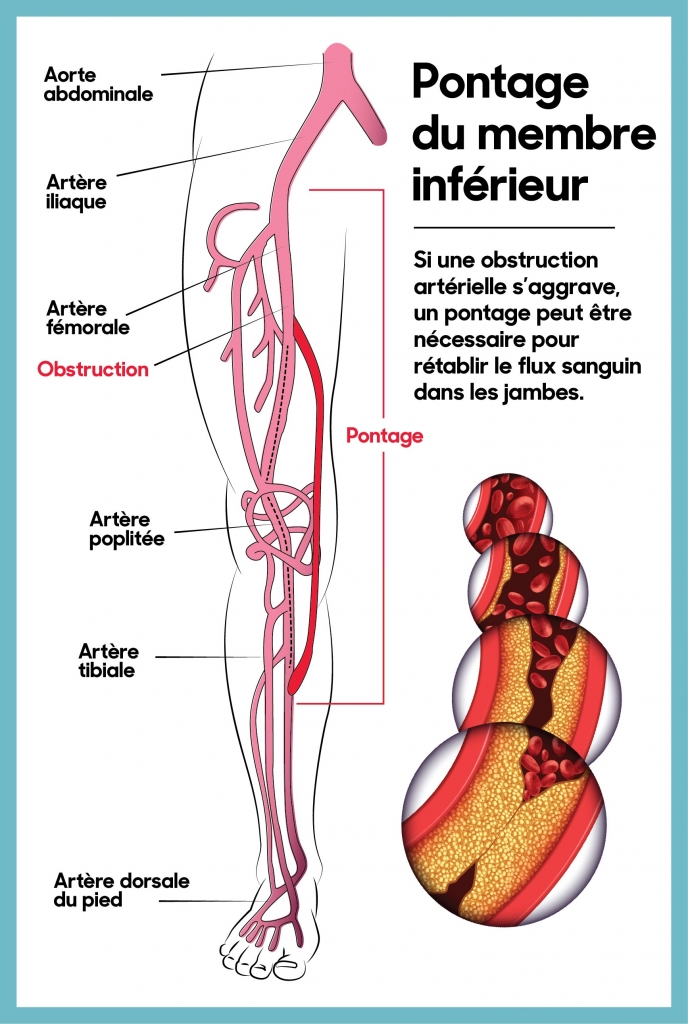 Si une obstruction artérielle s’aggrave, un pontage peut être nécessaire pour rétablir le flux sanguin dans les jambes.