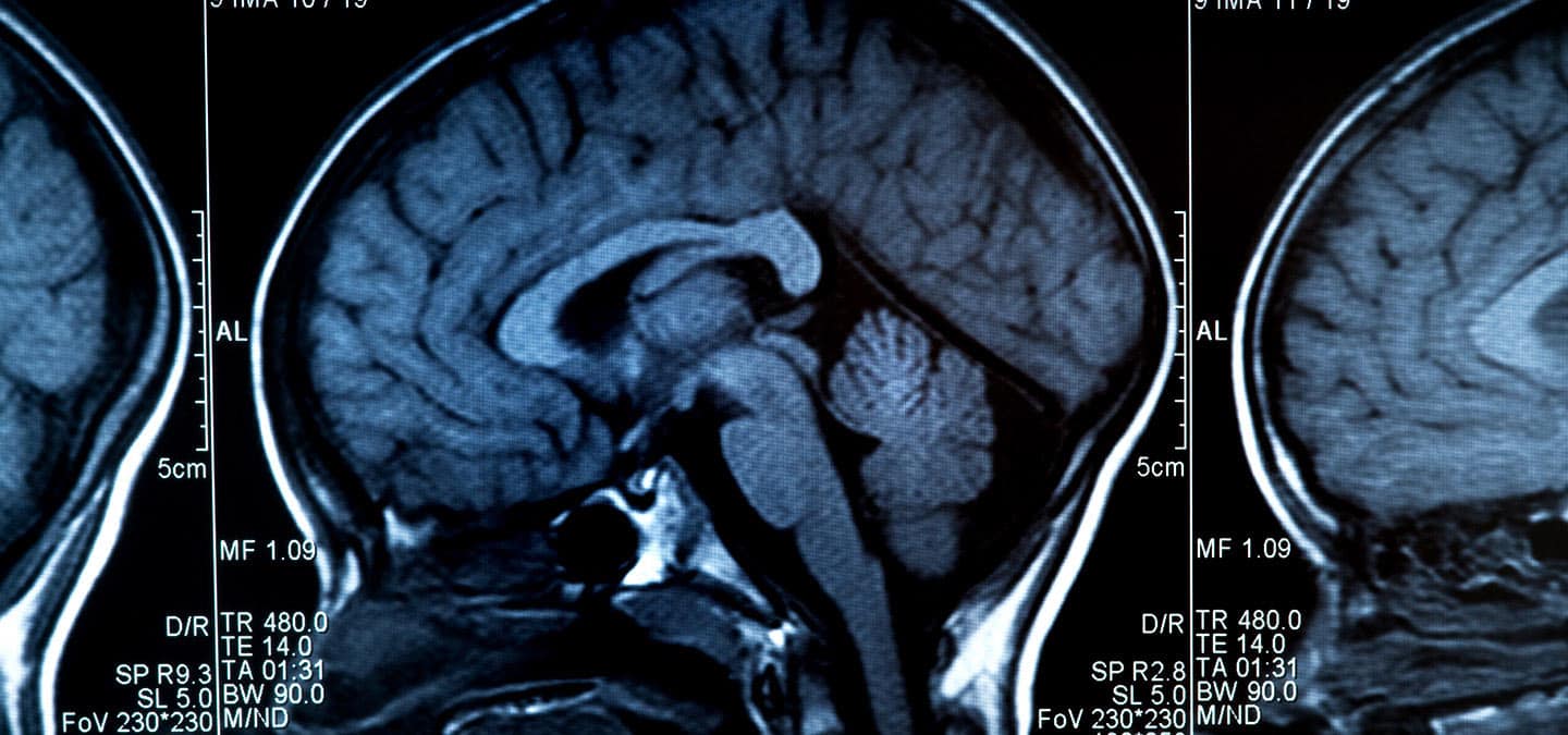 scan of brain