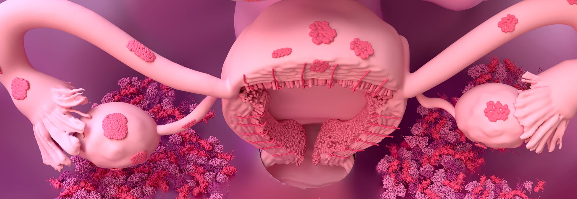 All about endometriosis