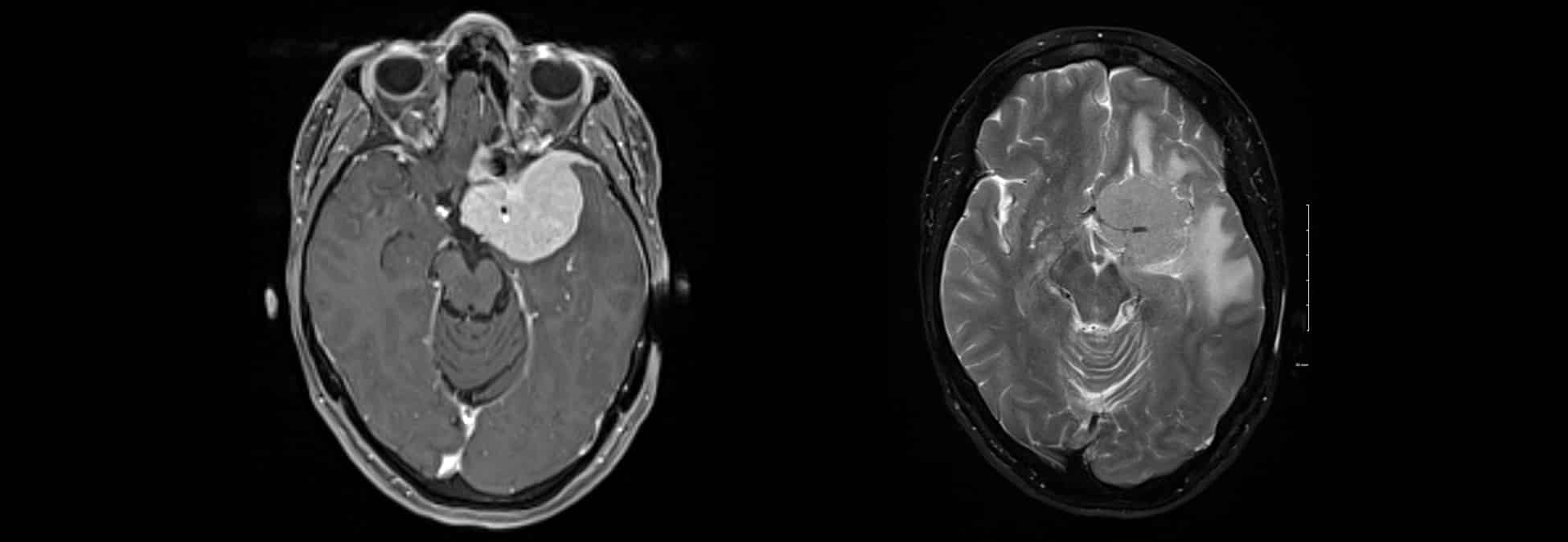 Meningioma_HERO