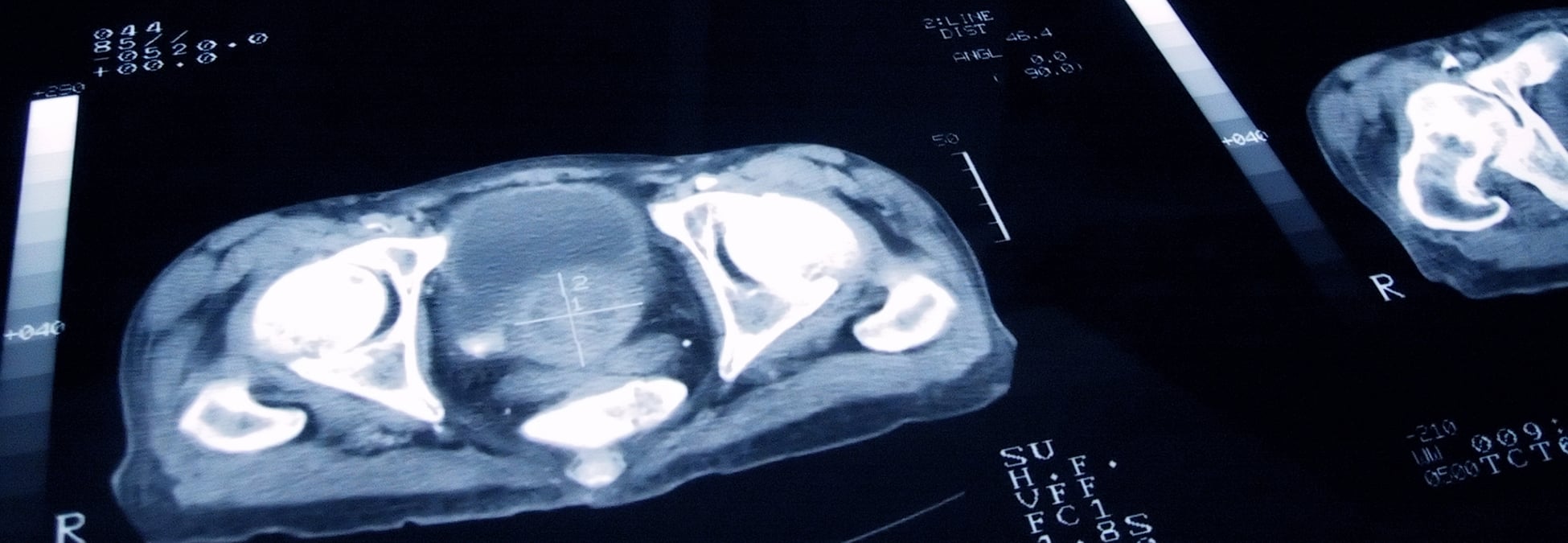 Prostate Cancer Slide